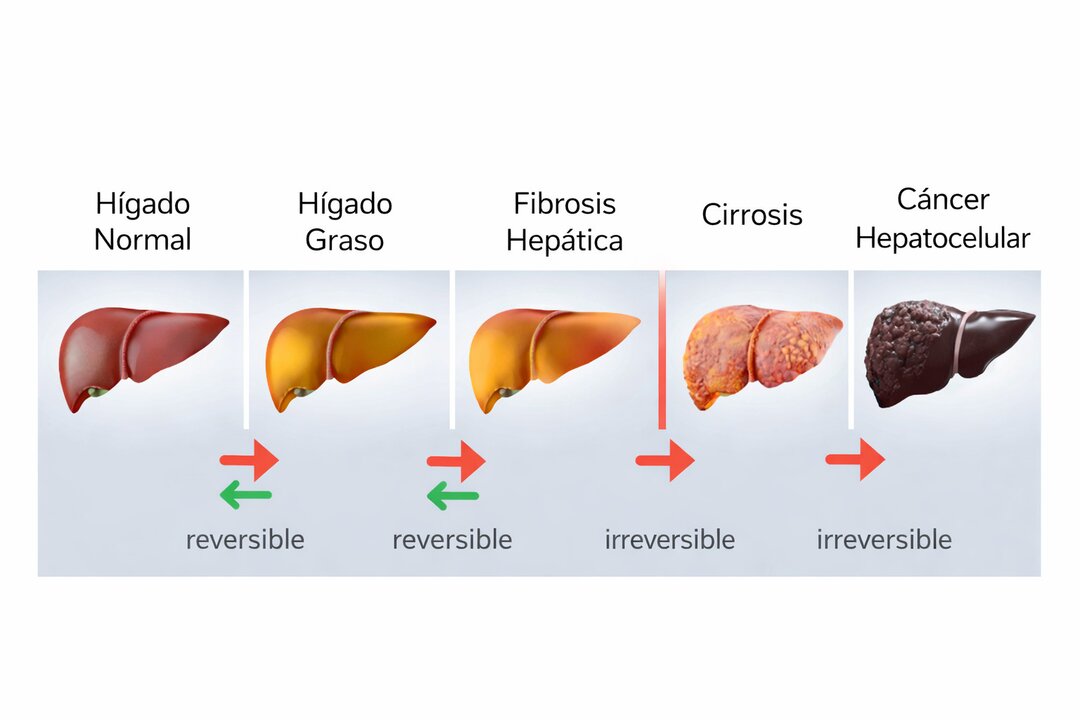 Progreso de enfermedades hepáticas